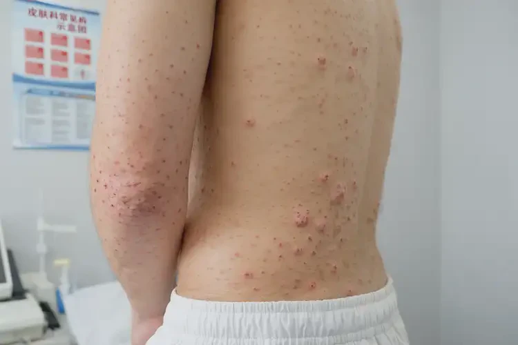 男生屁股上偶爾長濕疹可不可以根治(圖4)