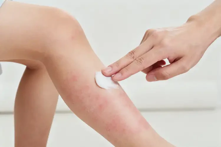 小孩小腿上經(jīng)常長濕疹可以治好嗎(圖1)