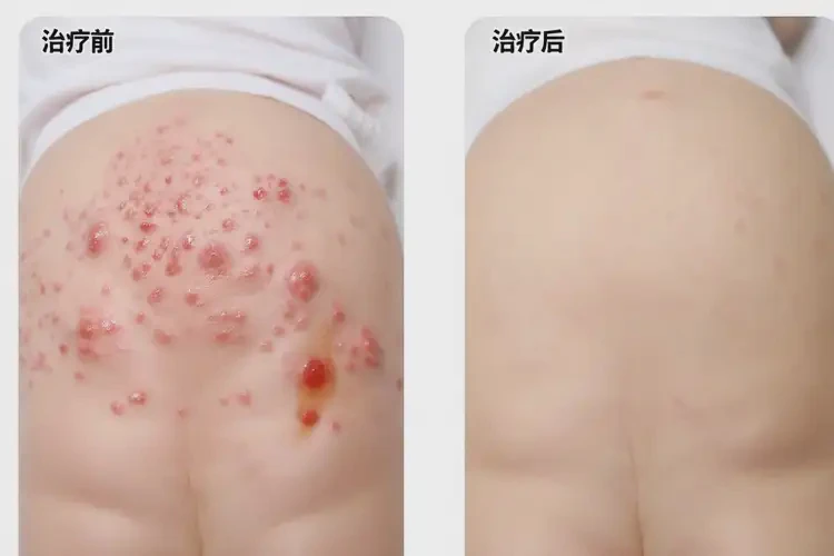 少兒肛周出現(xiàn)濕疹可以治好嗎(圖4)