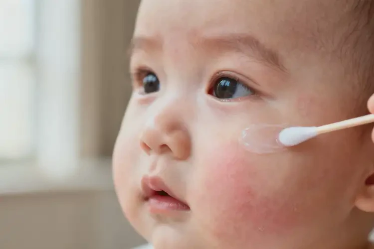 嬰兒臉上偶爾長濕疹可以治好嗎(圖2)