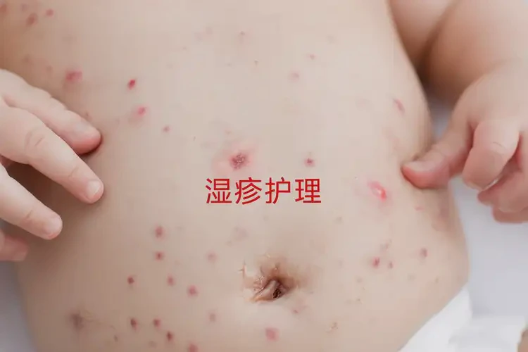 寶寶肚子出現(xiàn)濕疹可以治好嗎(圖4)