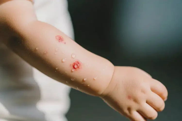 小孩手臂上偶爾起濕疹可以治好嗎(圖2)