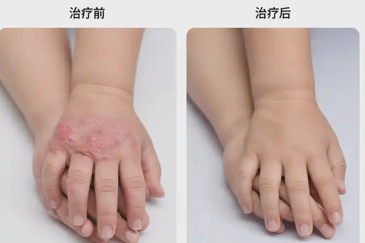 小孩手上起濕疹可以治好嗎(圖4)