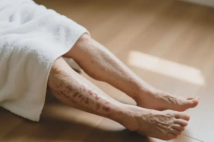 老年人全身出現(xiàn)濕疹可以治好嗎(圖1)