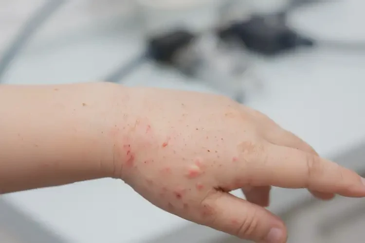 兒童手上長(zhǎng)濕疹可以治好嗎(圖4)