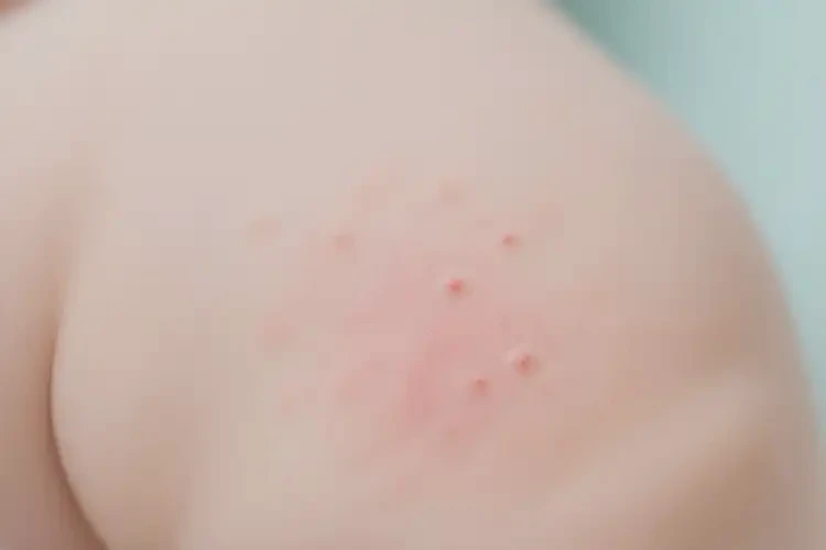 嬰幼兒屁股上偶爾長(zhǎng)濕疹可以治好嗎(圖2)