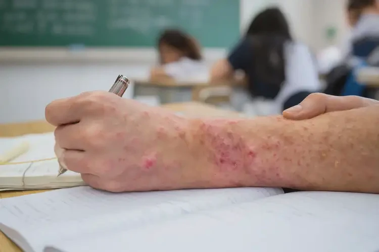 中學生手上偶爾起濕疹可不可以根治(圖4)