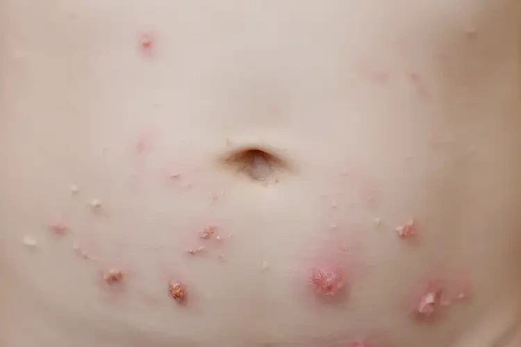 兒童肚子出濕疹不管它會(huì)自己自愈嗎(圖4)