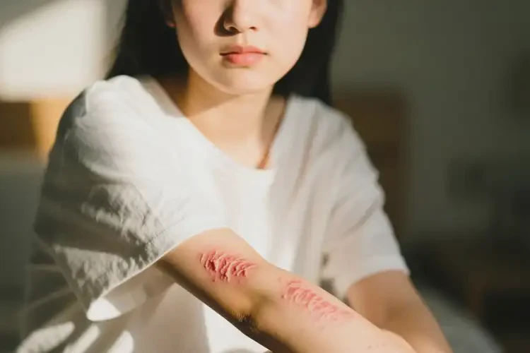 女生身上偶爾長濕疹可不可以根治(圖4)