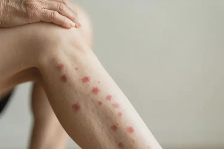 老人小腿上偶爾起濕疹可以治好嗎(圖4)