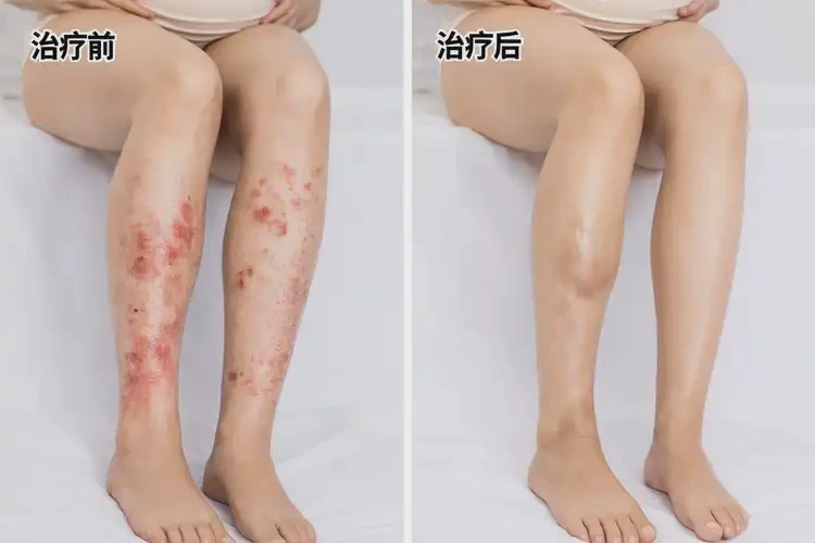 孕婦小腿經(jīng)常長(zhǎng)濕疹可以治好嗎(圖4)
