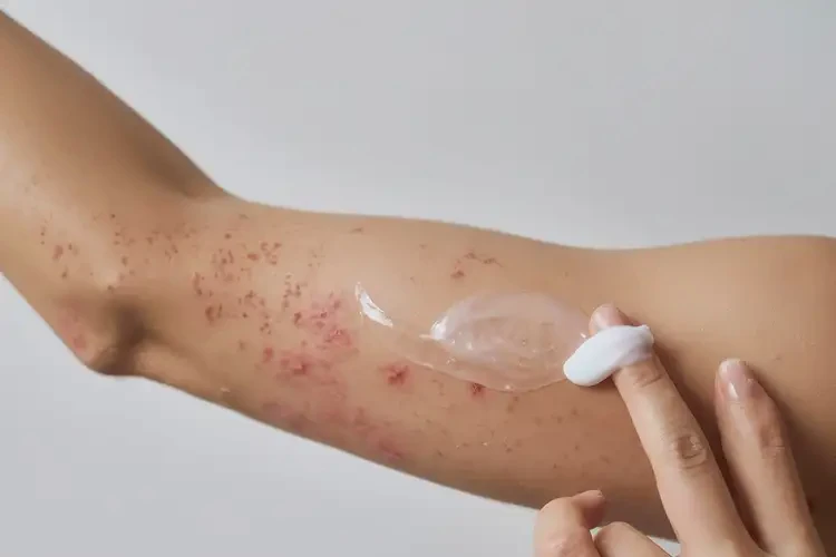 女人手臂上容易長(zhǎng)濕疹可不可以根治(圖3)