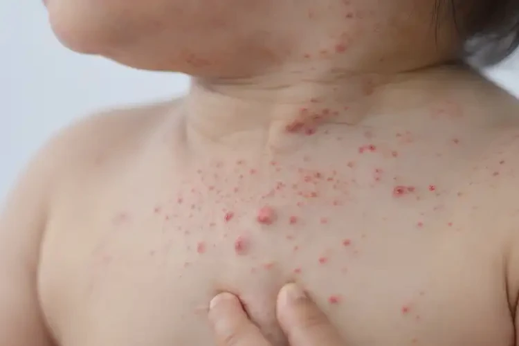 幼兒脖子經(jīng)常起濕疹可不可以根治(圖4)