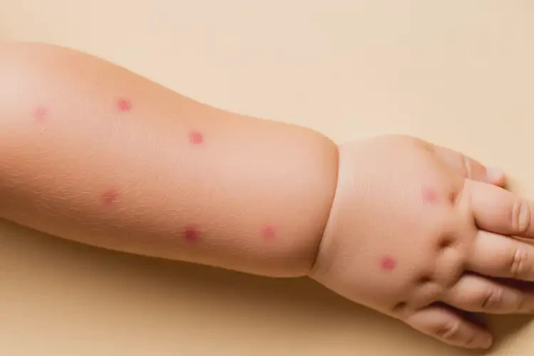 寶寶手臂出濕疹可以治好嗎(圖2)