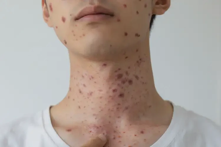 男生脖子上有濕疹可不可以根治(圖4)