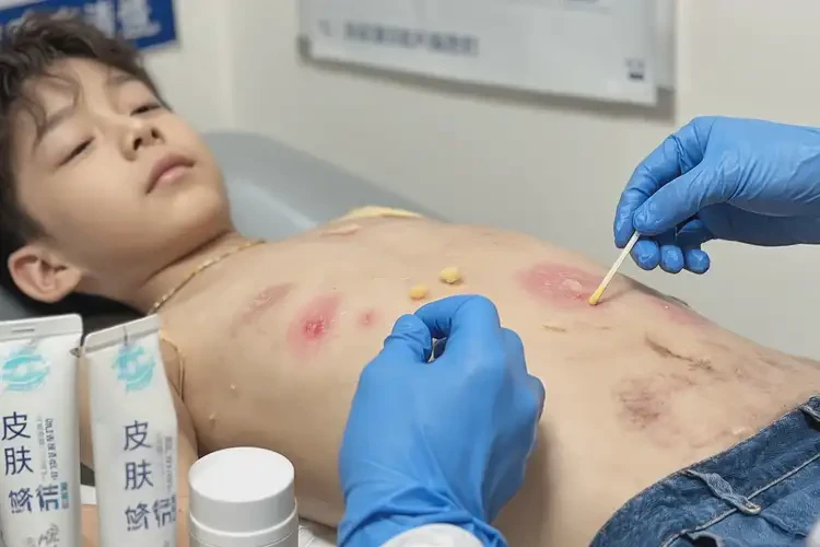 青少年肚子有濕疹可不可以根治(圖4)