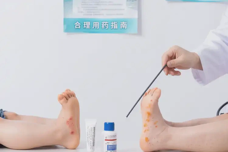 小兒腳上有濕疹可不可以根治(圖3)