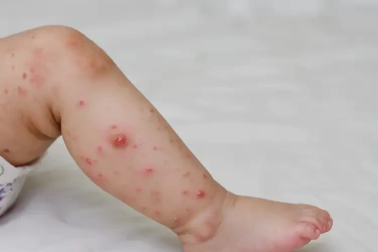 寶寶小腿出現(xiàn)濕疹可以治好嗎(圖4)