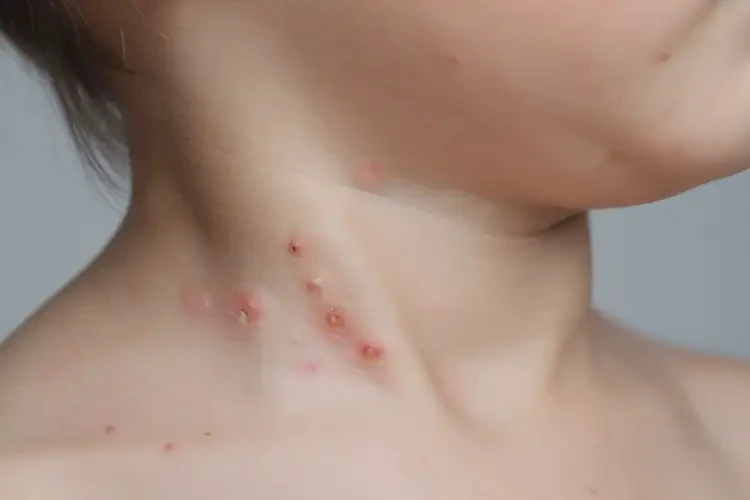 小兒脖子容易起濕疹可以治好嗎(圖4)