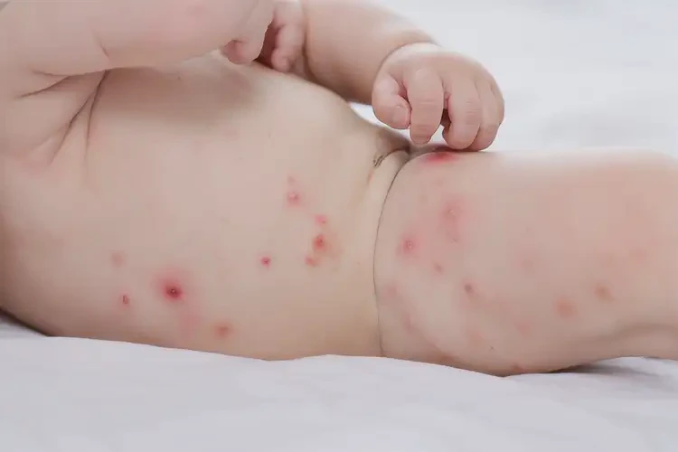 嬰兒肚子上出現(xiàn)濕疹能夠徹底治愈嗎(圖4)
