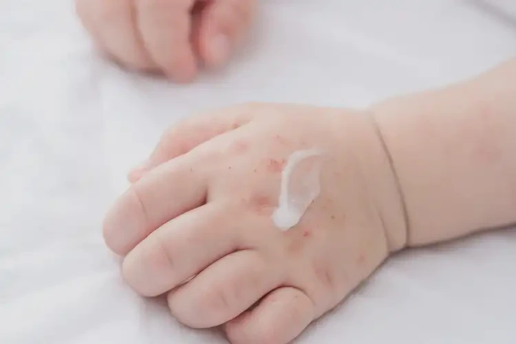 嬰兒手上出現(xiàn)濕疹可以治好嗎(圖3)