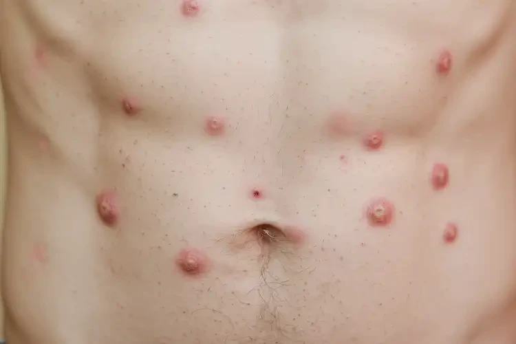 男生肚子偶爾長(zhǎng)濕疹可以治好嗎(圖4)