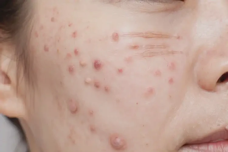 大学生肚子上经常起湿疹可不可以根治(图4)