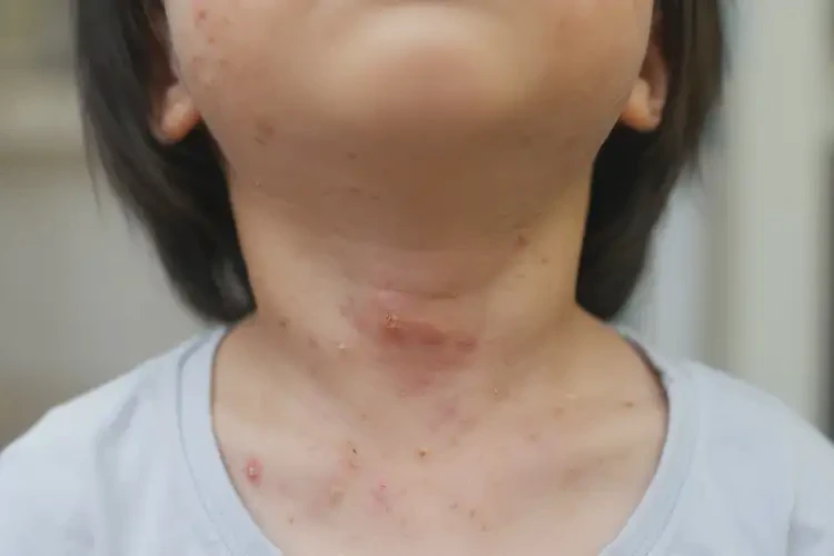 孩子脖子起濕疹不管它會(huì)自己自愈嗎(圖4)
