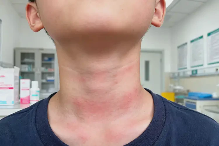 青少年脖子上偶爾長(zhǎng)濕疹可不可以根治(圖4)