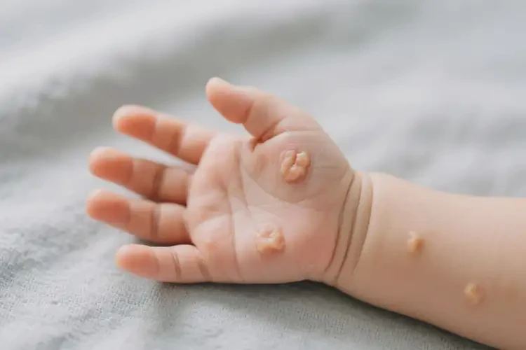 新生兒手上偶爾起濕疹可不可以根治(圖2)