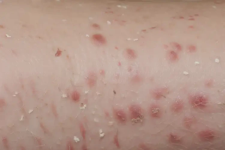 新生兒臉上出現(xiàn)濕疹不管它會自己好嗎(圖3)