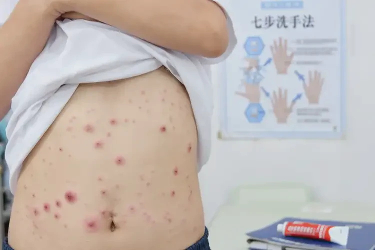 中學(xué)生肚子上容易長濕疹可以徹底自愈嗎(圖4)