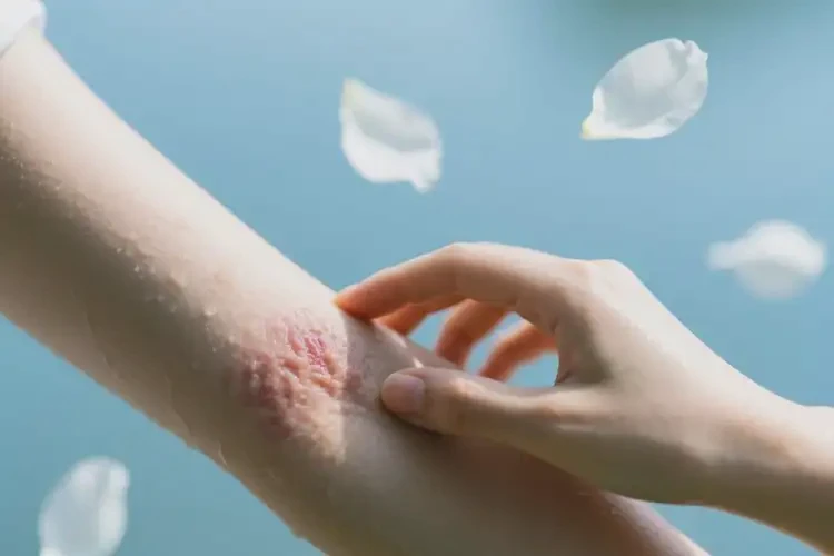 青年人手臂經(jīng)常長(zhǎng)濕疹可不可以根治(圖3)