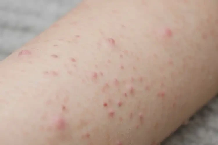 女生身上容易起濕疹不管它會自己好嗎(圖4)