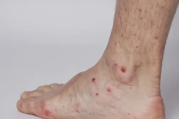 大學(xué)生腳上起濕疹能徹底自愈嗎(圖4)