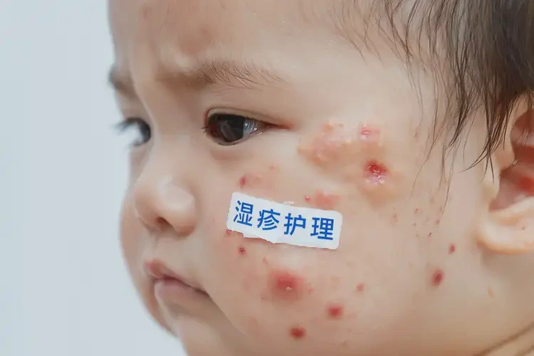 幼兒面部出現(xiàn)濕疹可以治好嗎(圖3)