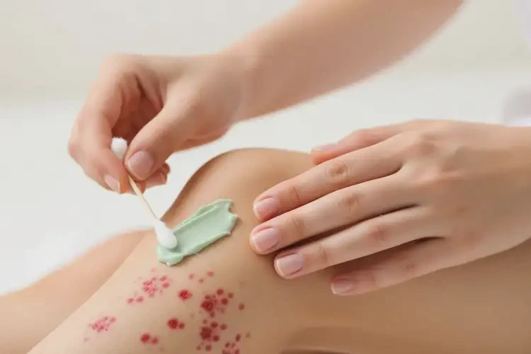 青年人大腿容易长湿疹可不可以根治(图3)