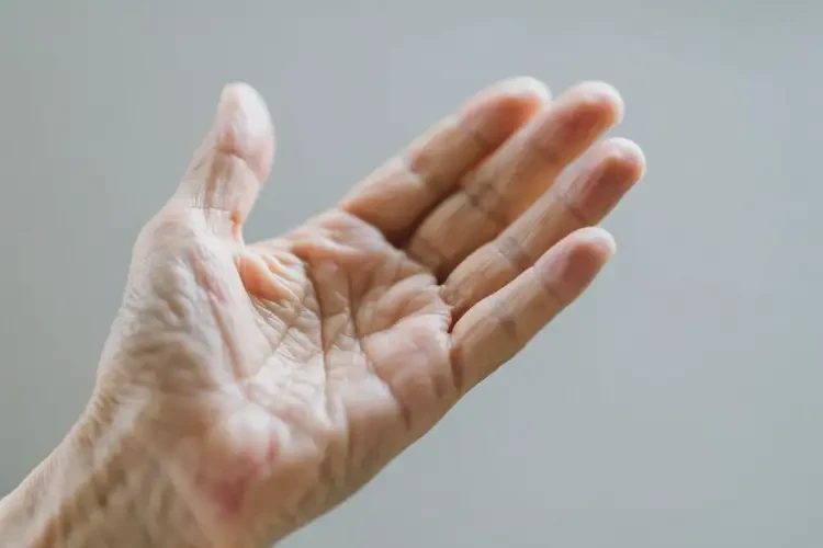 老年人手上偶爾起濕疹可以治好嗎(圖2)