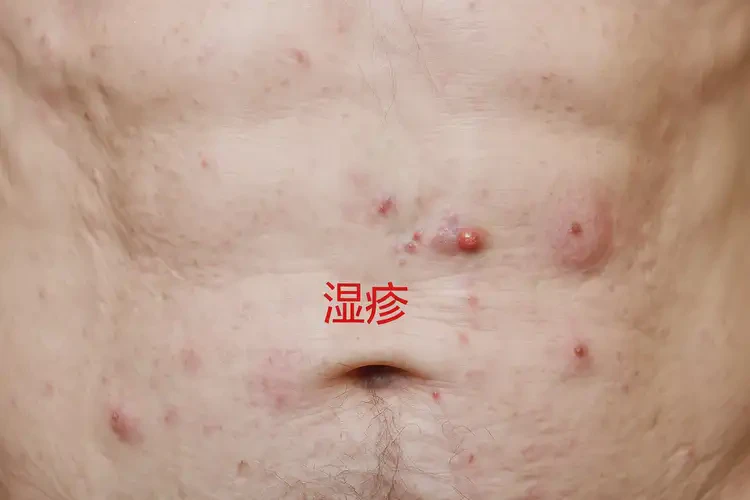 老年人肚子上容易起濕疹可以治好嗎(圖4)