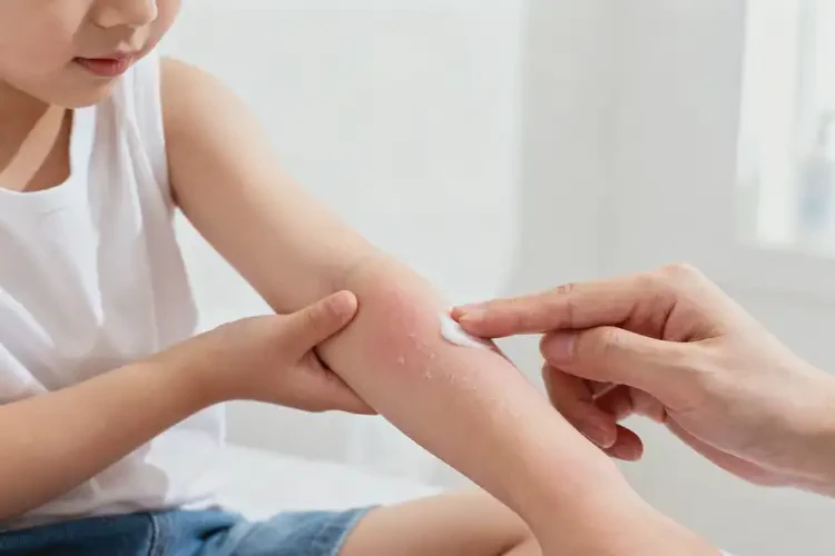 兒童手臂經(jīng)常起濕疹能靠自己自愈嗎(圖3)