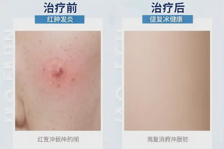 少兒小腿上經(jīng)常長濕疹可以治好嗎(圖4)