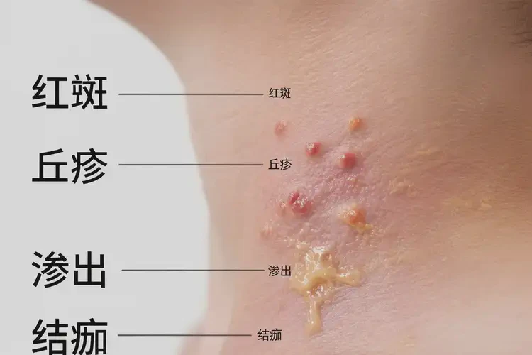 孩子脖子上起濕疹可以治好嗎(圖2)