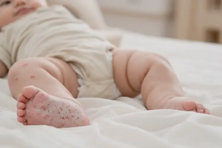 嬰幼兒大腿上起濕疹可以治好嗎(圖3)