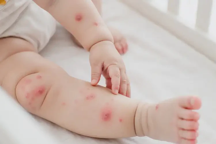 嬰兒大腿容易長(zhǎng)濕疹可以治好嗎(圖4)