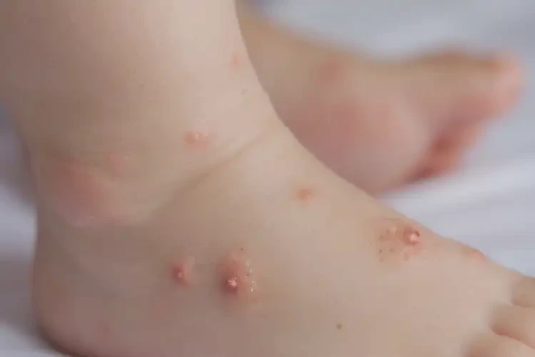 小孩腳上經(jīng)常起濕疹能靠自己自愈嗎(圖4)