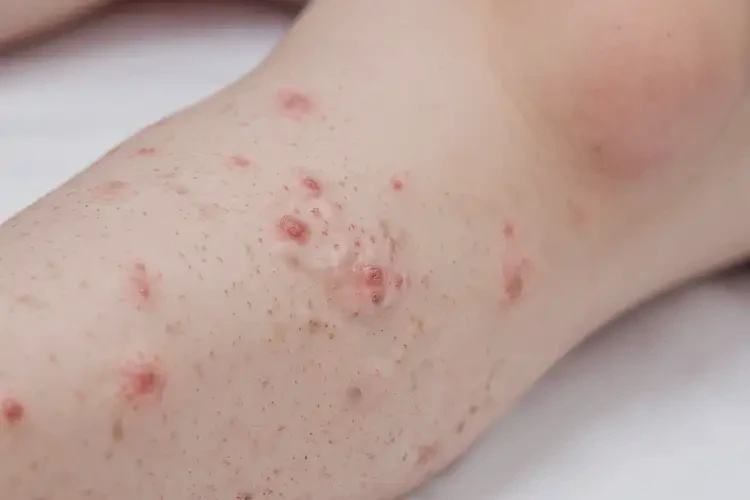 儿童小腿上经常起湿疹可以治好吗(图4)