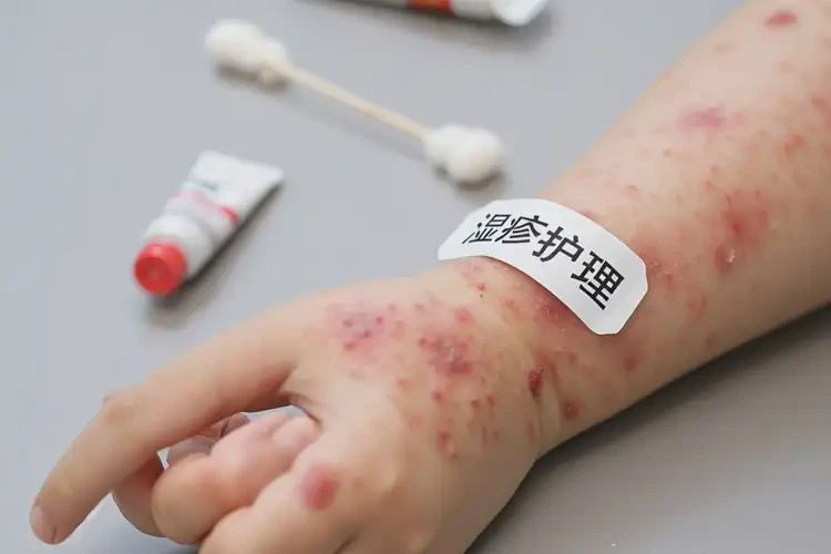兒童手臂上起濕疹可以治好嗎(圖4)