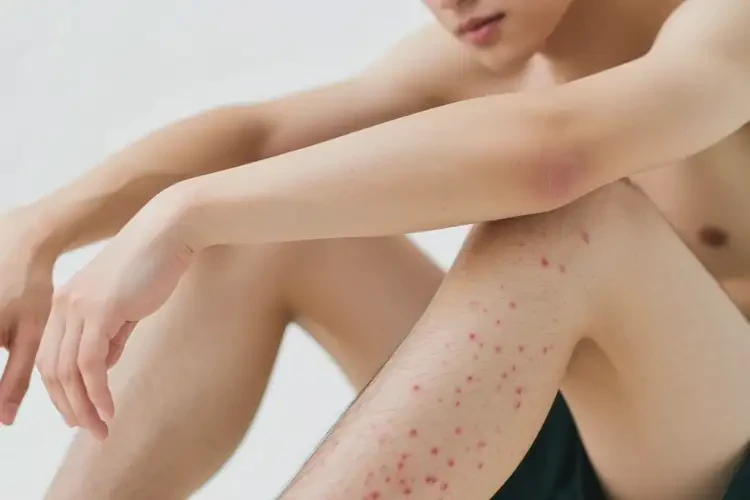 男生四肢長(zhǎng)濕疹可以治好嗎(圖3)