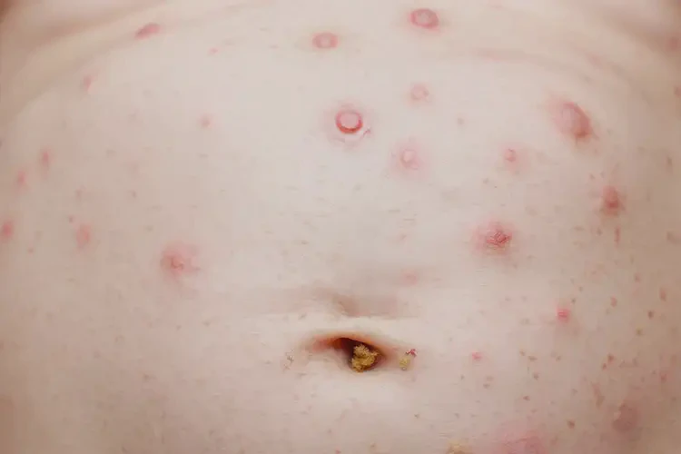 新生兒肚子上經(jīng)常長濕疹可不可以根治(圖3)