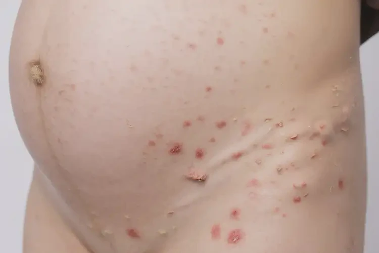 孕婦小腿出現(xiàn)濕疹不管它會自己痊愈嗎(圖4)